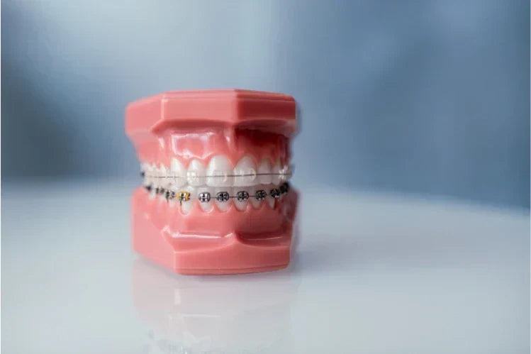 A dental model with metal braces on the bottom teeth and ceramic braces on the upper teeth.