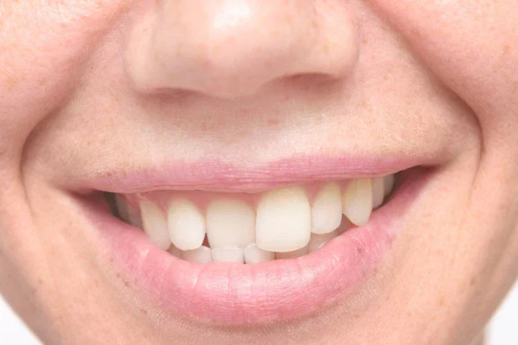 A person shows her slanted front teeth 