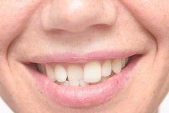 Straighten Slanted Front Teeth with Smilepath Clear Aligners: A Convenient and Affordable Solution