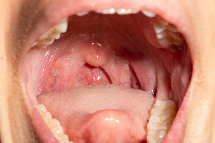 Path Teeth Posterior Teeth Problems: Causes, Treatment & Prevention
