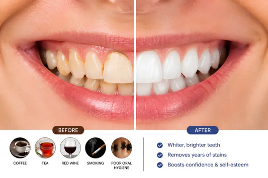 Before and after teeth whitening showing removal of yellow and brown tooth stains