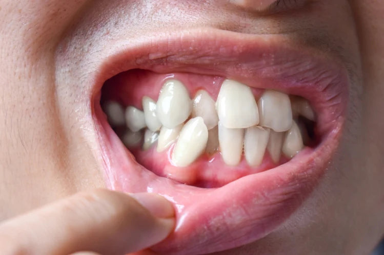 overlapping teeth