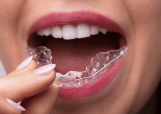 The Convenience of Clear Aligners