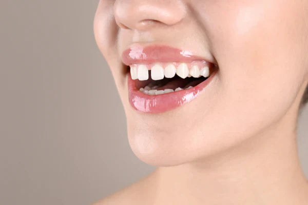 How to Fix Gaps in Teeth without Metal Braces