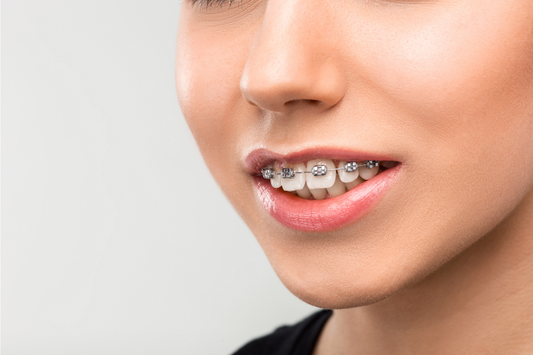 Close-up of overbite smile with braces