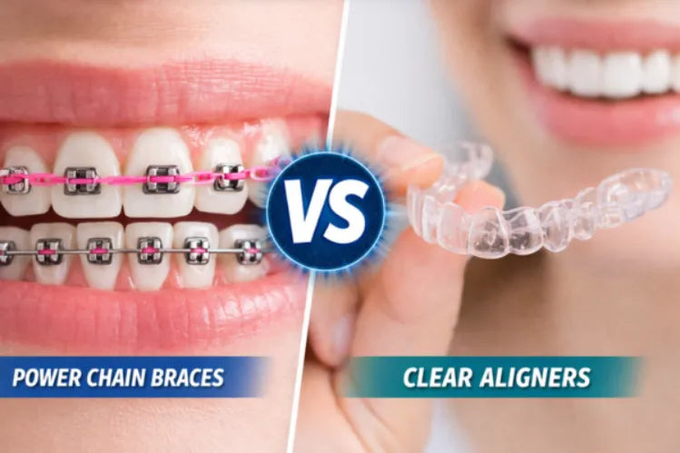 A side-by-side comparison of Powerchain braces vs Aligners