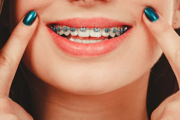 Should I Avoid Certain Colors With Braces?