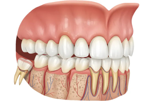 Wisdom tooth removal 