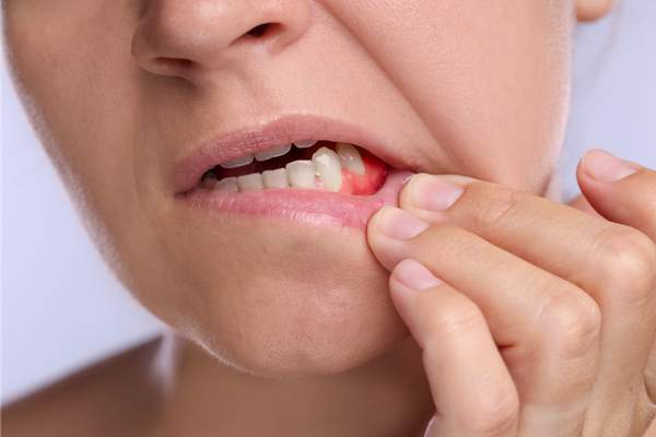 An image shows a girl showing gum inflammation