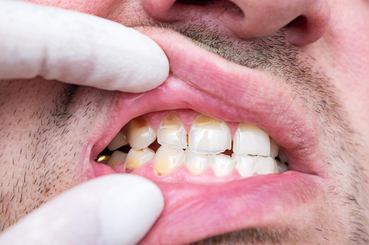  A close-up of a chipped front tooth