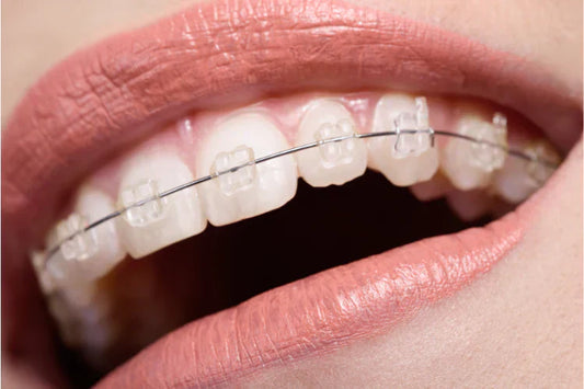 A person smiling with Ceramic Braces 