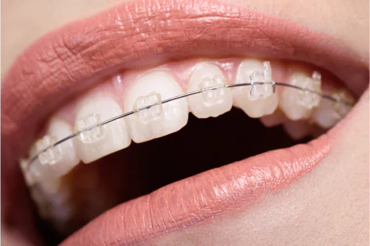 A person smiling with Ceramic Braces 