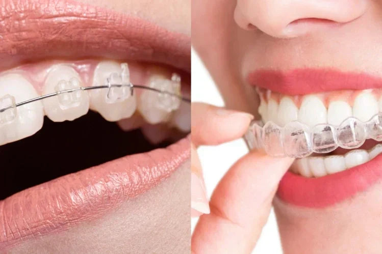 A side by side comparison of clear braces and ceramic braces