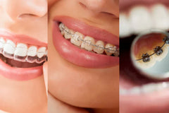 Braces Types Explained – From Metal to Invisible Options
