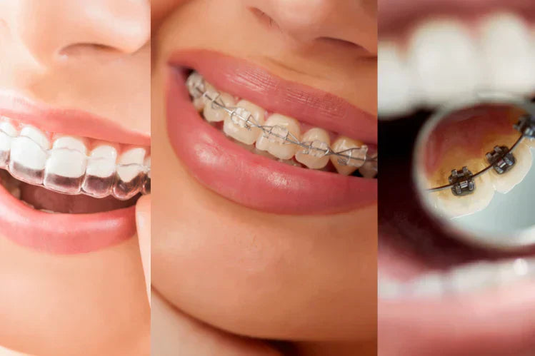A side-by-side image of the types of braces applied to women's teeth