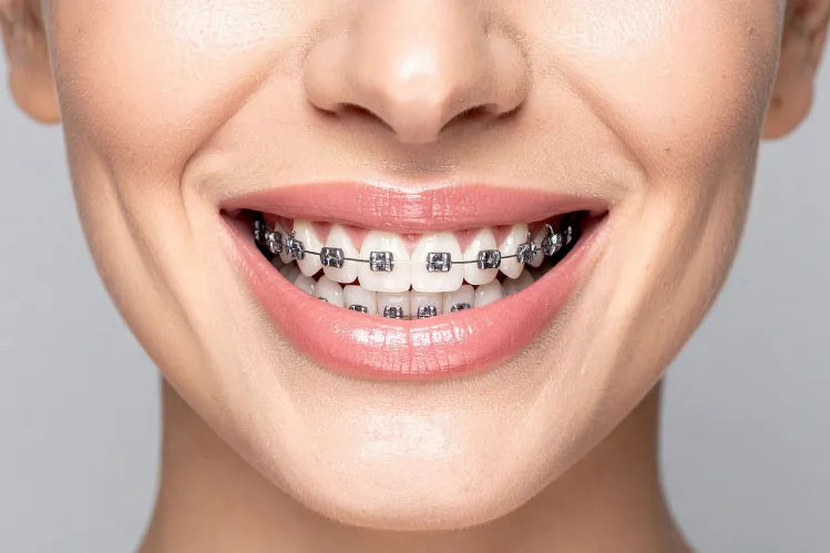 A model with a close-up shot of braces smile.
