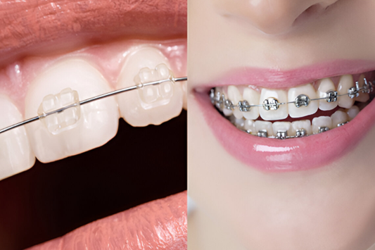 Traditional metal braces and ceramic braces side-by-side.