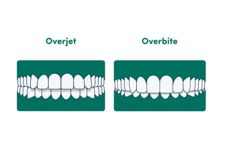  An illustration of an overjet versus an  overbite 