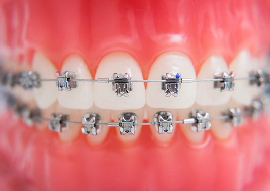 What-is-Plaque-and-What-Can-You-Do-About-Plaque-on-Teeth-With-Braces