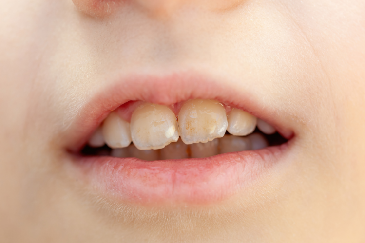 A child showing white spots on teeth 