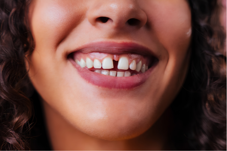 A close-up image showing a gap in the front teeth.