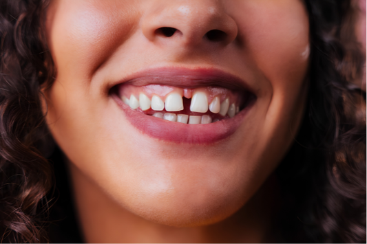 A close-up image showing a gap in the front teeth.