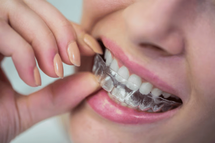 Teeth straightening options - clear aligner, ceramic braces, and lingual braces.