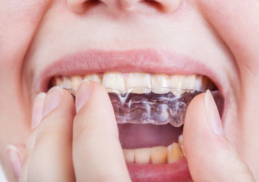 A woman inserting clear aligner
