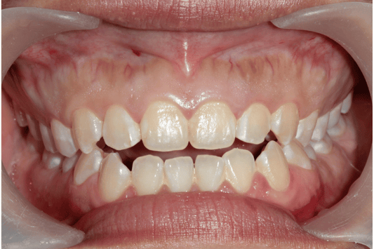 Close up of Anterior Open Bite