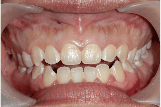 Close up of Anterior Open Bite