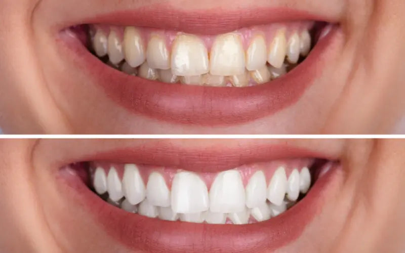 The Ultimate Guide to the Best Teeth Whitening Kit for a Brighter Smile!