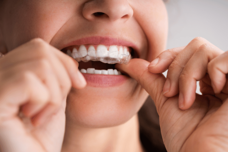 Are clear aligners a safe option?