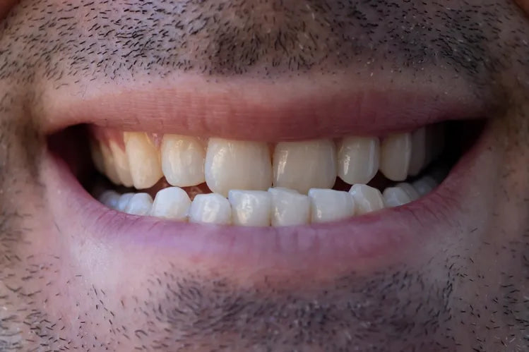 A close-up of a man suffering from an underbite