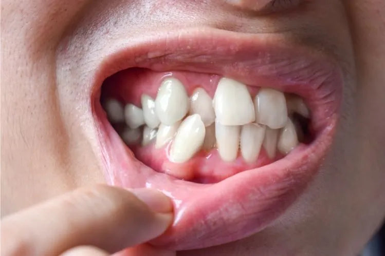A boy is showing his crooked teeth