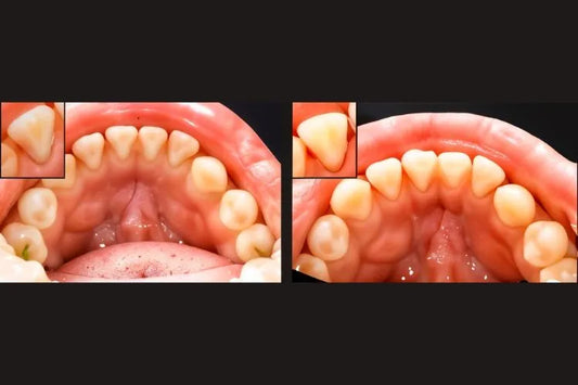 Close up of relapsed teeth