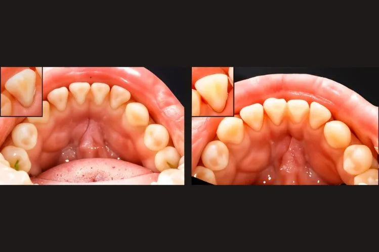 Close up of relapsed teeth