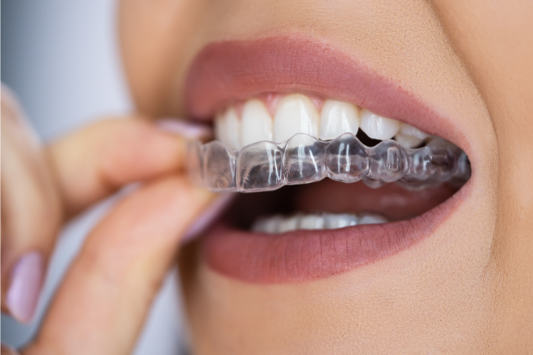 A girl fixing crossbite with clear aligners