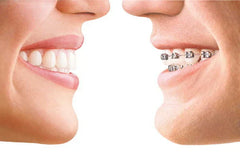 Braces or Aligners: Which One Gives Faster & Better Results?
