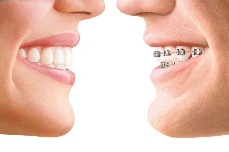 Clear Braces or Aligners: the right teeth straightening solution.
