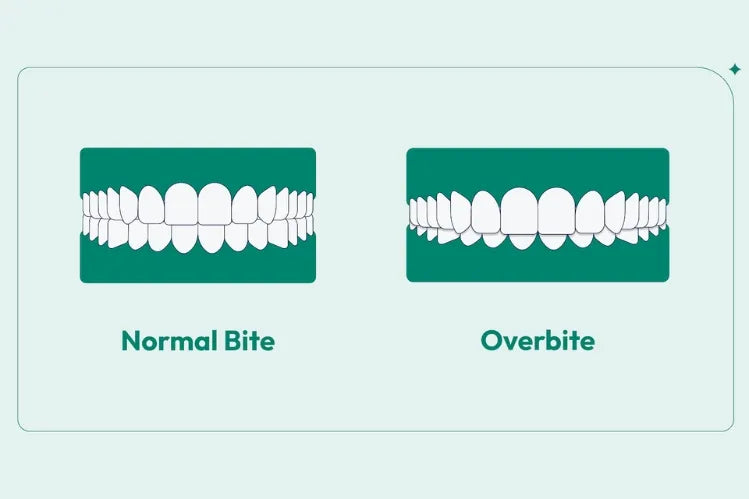 An illustration showing a comparison between a normal bite vs an overbite