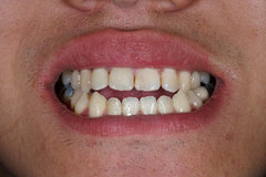 Correcting Your Open Bite with Smilepath Australia’s Clear Aligners