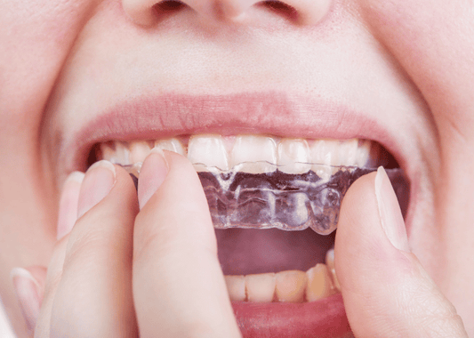 Orthodontic Treatment with clear aligners