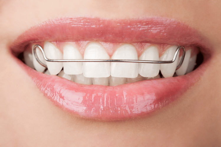 Close-up of person’s teeth, wearing metal retainers