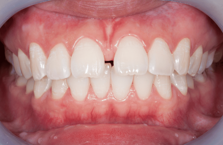 Clear Aligners for Diastema: How Clear Aligners Help Fixing Teeth Gaps