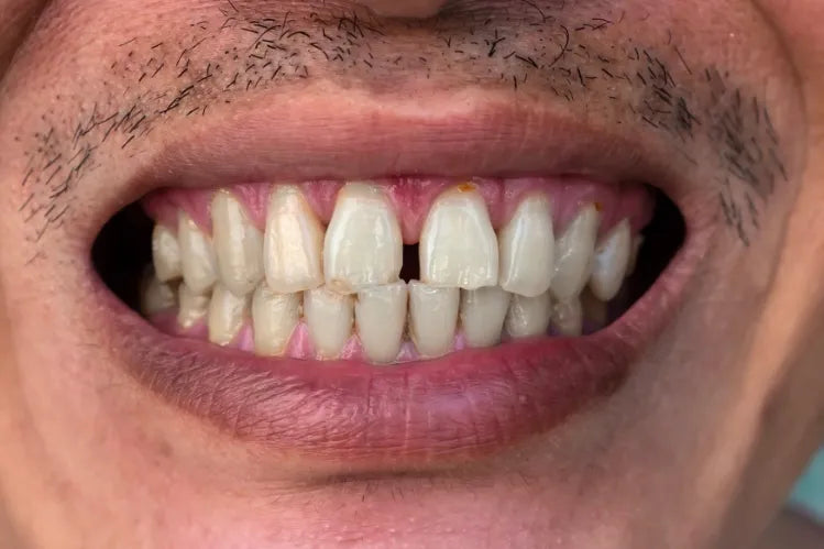 A close-up of a man's teeth with a huge gap in the front or incissors