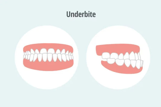 underbite