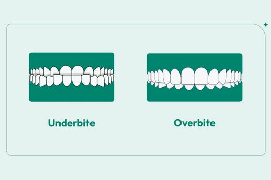 An image showing an underbite and overbite