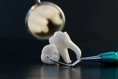 Wisdom Teeth and Teeth Straightening: What You Need to Know