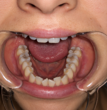 Clear Aligners for Straighter Teeth at Home | SmilePath Australia