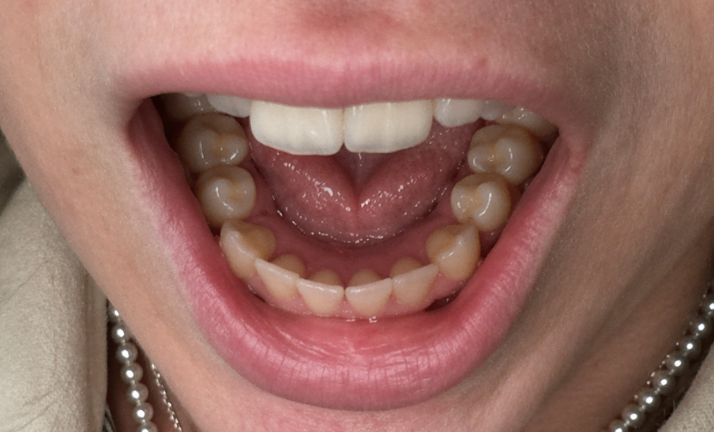 Clear Aligners for Straighter Teeth at Home | SmilePath Australia
